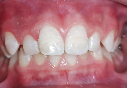 兒童牙齒清潔法寶 牙間隙色素清除有妙招